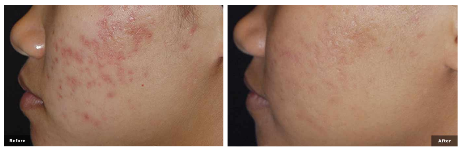 before after treatment surani clinic