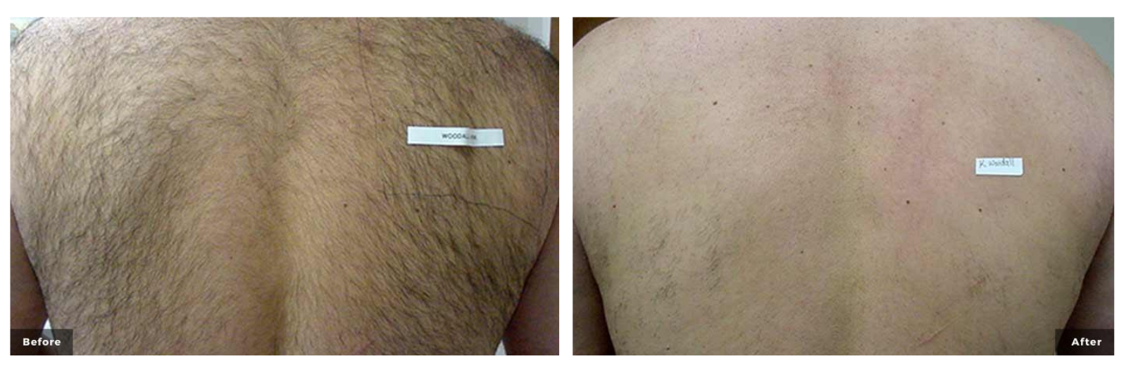 Laser hair removal men's back before and after images
