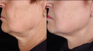 Titan skin tightening before and after pictures.