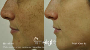 Sunspot treatment with Limelight Photofacial IPL before and after