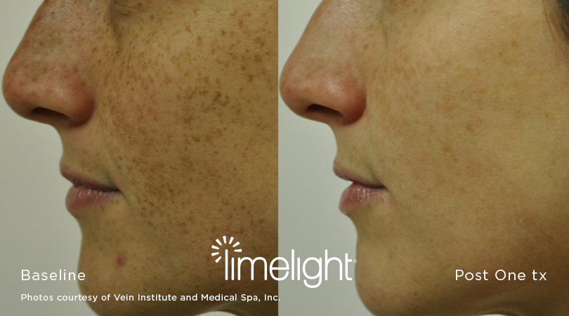 Limelight before and after
