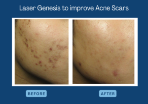 Laser Genesis in Toronto to improve acne scar