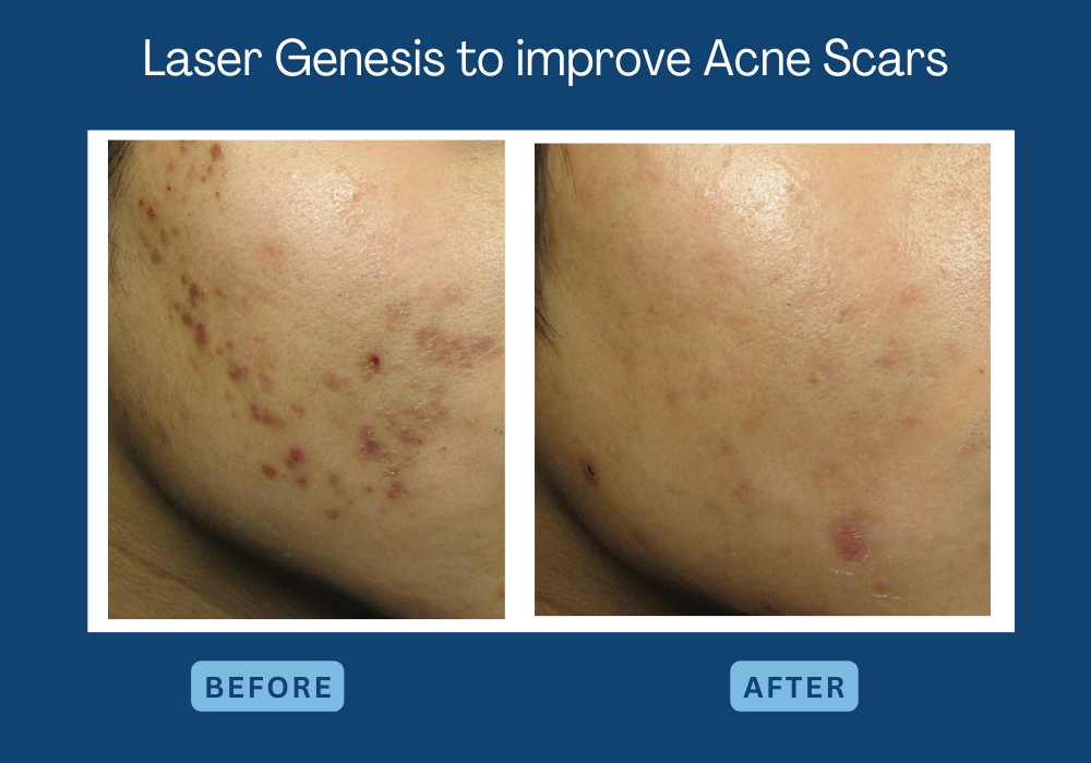Surani Clinic Toronto, Laser Genesis to improve acne scar
