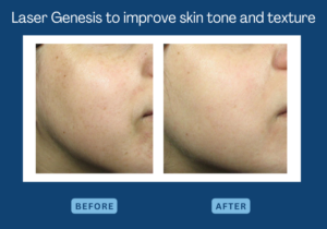 Laser Genesis to improve skin improve skin tone