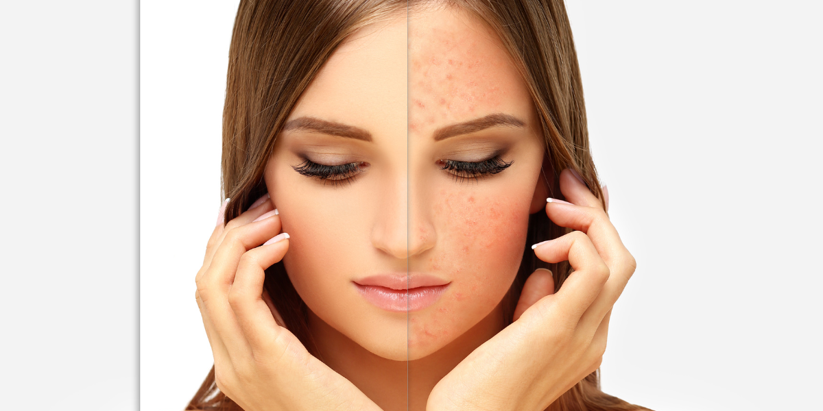Surani Laser Clinic Toronto - The Power of Laser Therapy for Rosacea