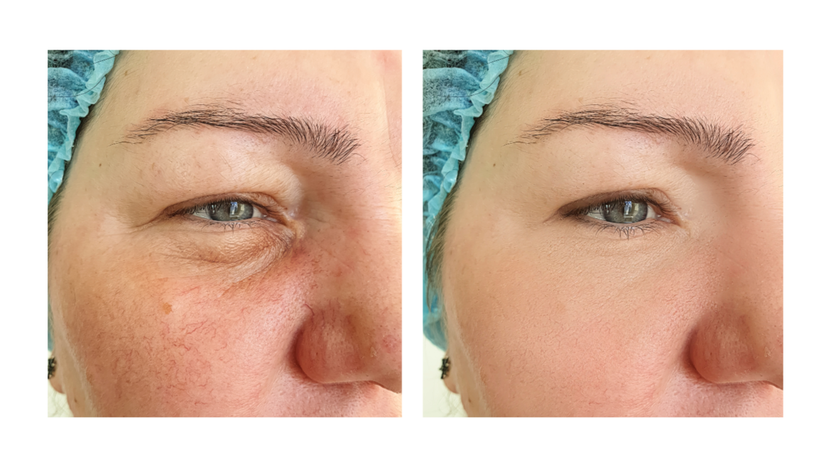 From Notorious to Nourishing: The Power of Laser Therapy for Rosacea